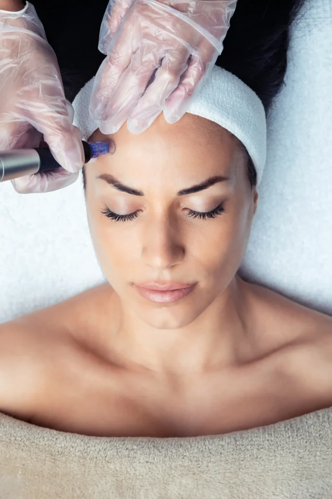 microneedling in stanmore