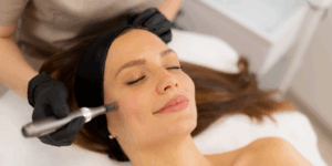 Microneedling in Stanmore
