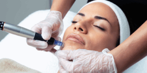 Microneedling in Stanmore