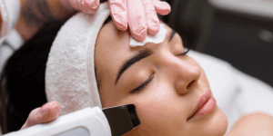 Microneedling in Stanmore