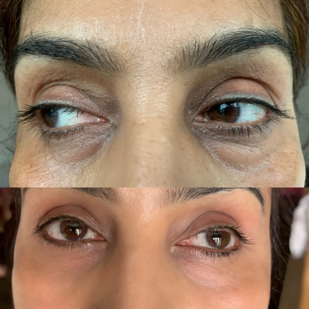 CO2 laser in Harrow