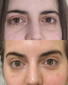CO2 laser in Harrow