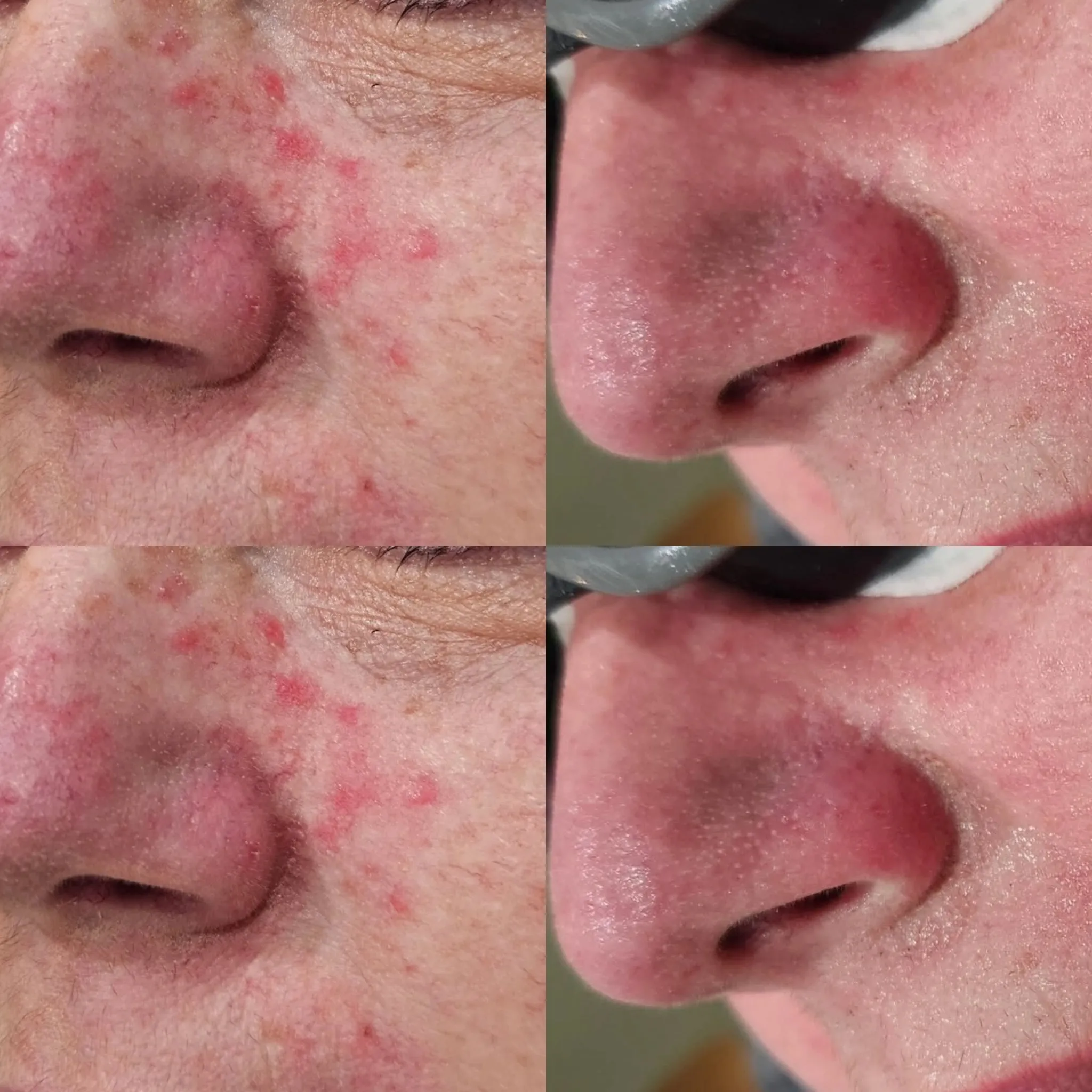 Blogs Acne Treatment in Harrow on the Hill