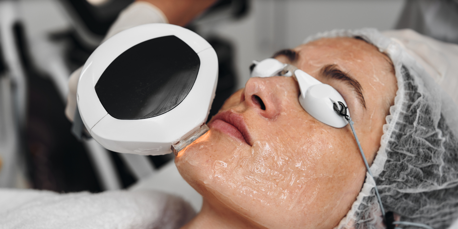 Blogs IPL Treatment in Pinner