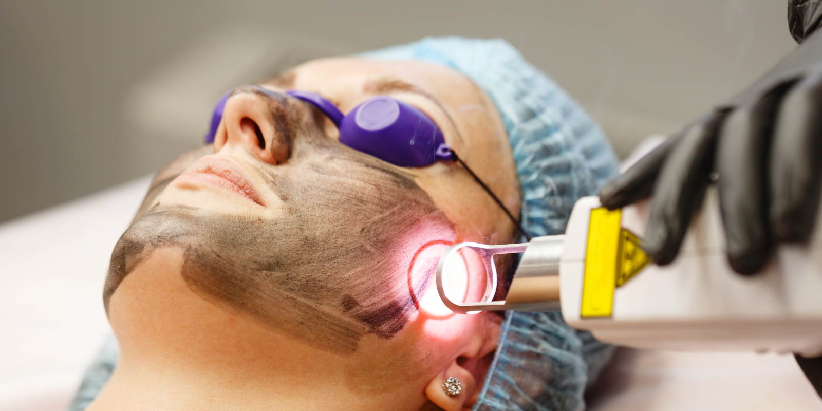 Blogs Co2 Laser in Edgware