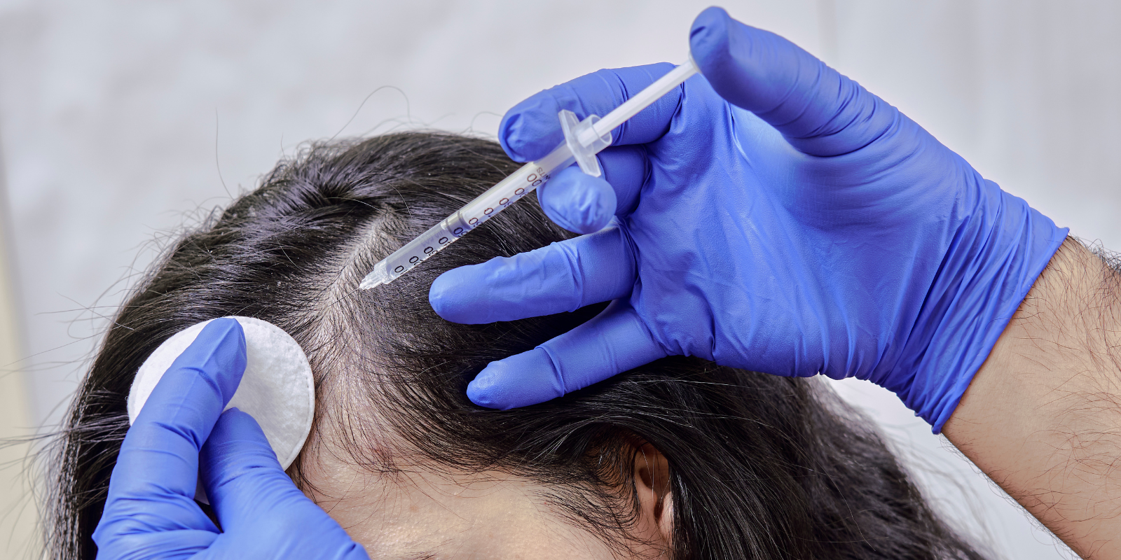 Blogs Exosome Therapy for Hair Growth in Harrow
