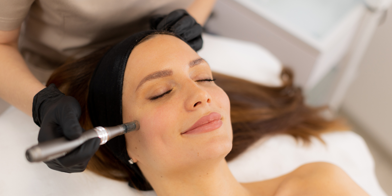 Microneedling with Exosomes in Harrow