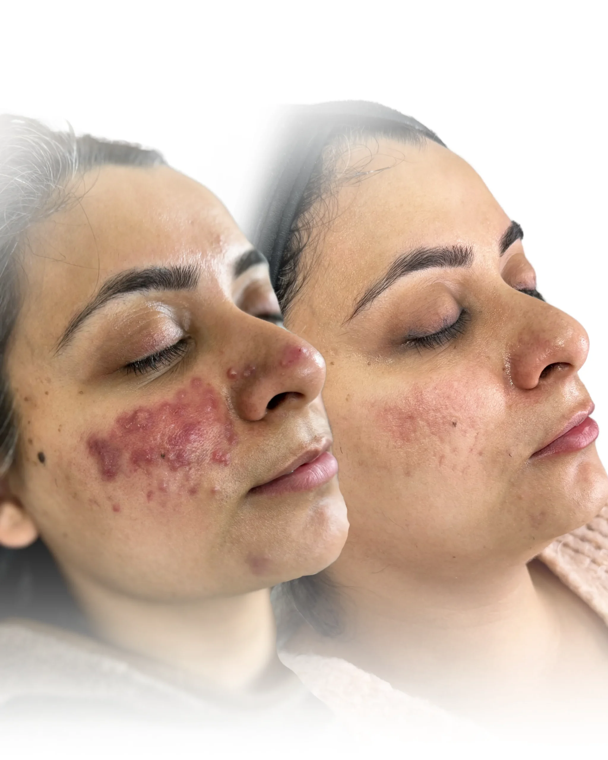 Blogs Pigmentation peel Services in Harrow