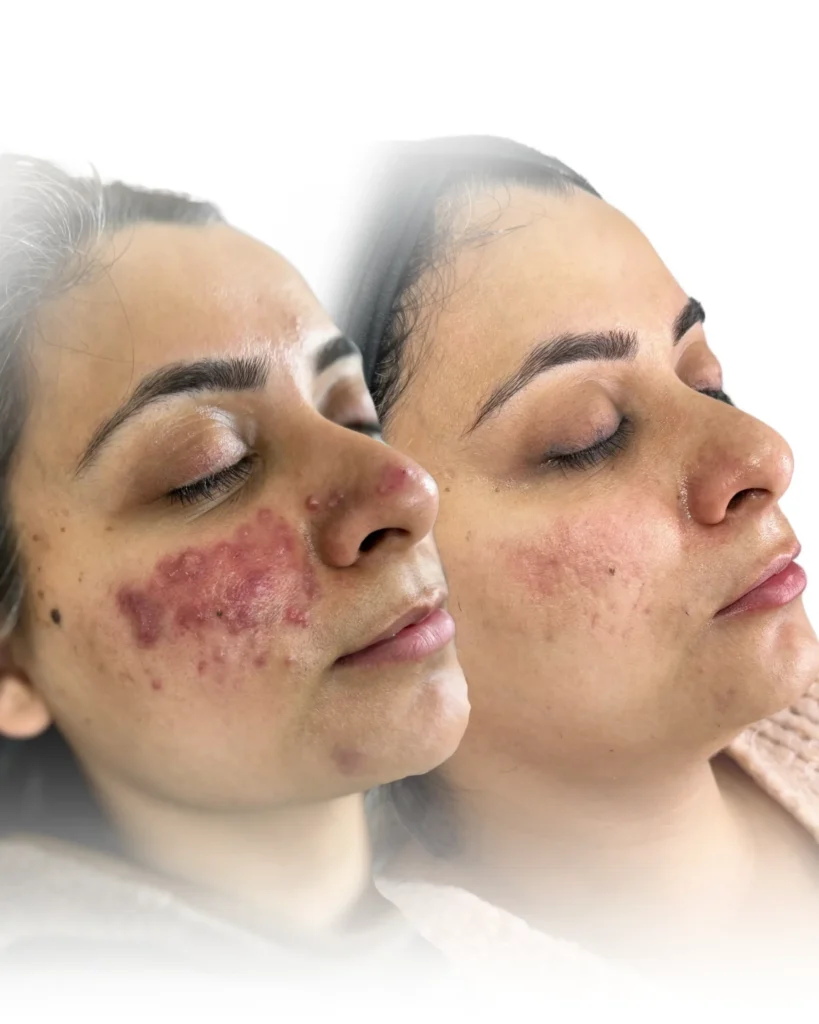 Acne Treatment in Harrow