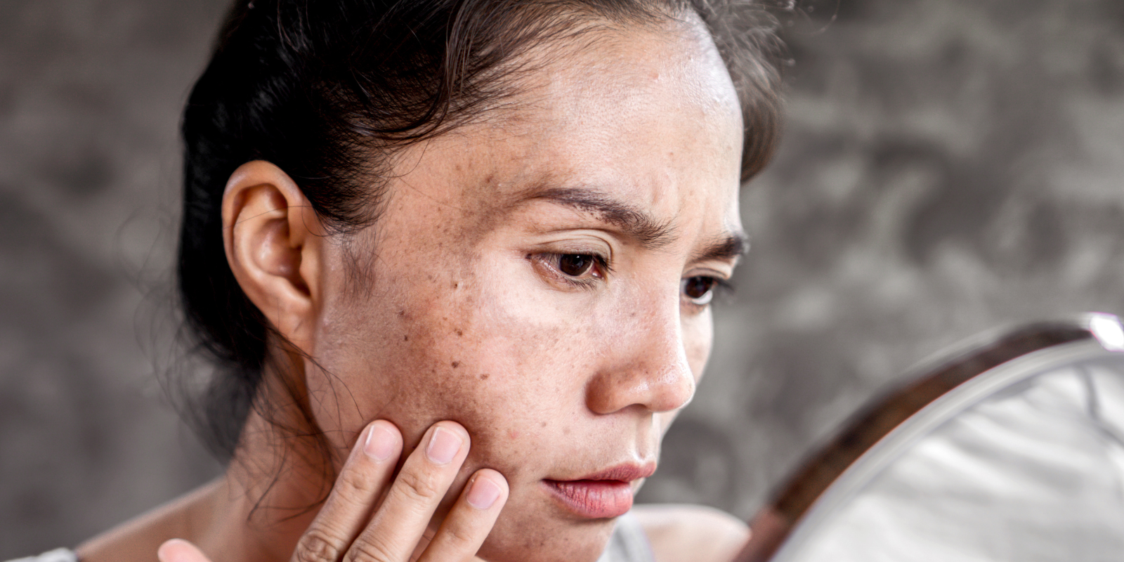 Blogs Post-Inflammatory Hyperpigmentation