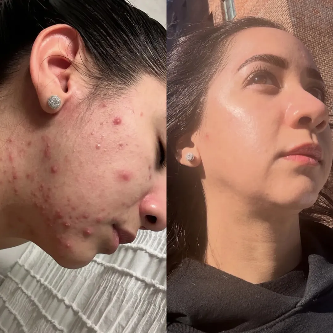 Home Acne Scar Treatment in Harrow on the Hill