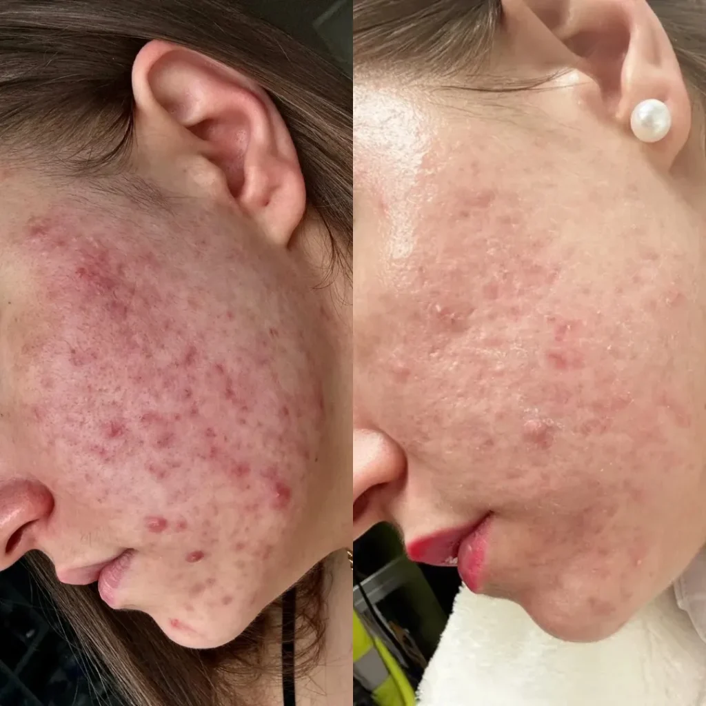 Adult Acne Treatment in Harrow
