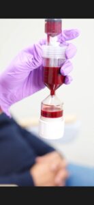 Autologous exosomes treatment for skin rejuvenation and hair growth in the UK