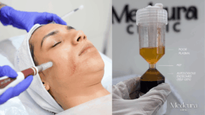Microneedling-vs-PRP-Medcura-Clinic-UK