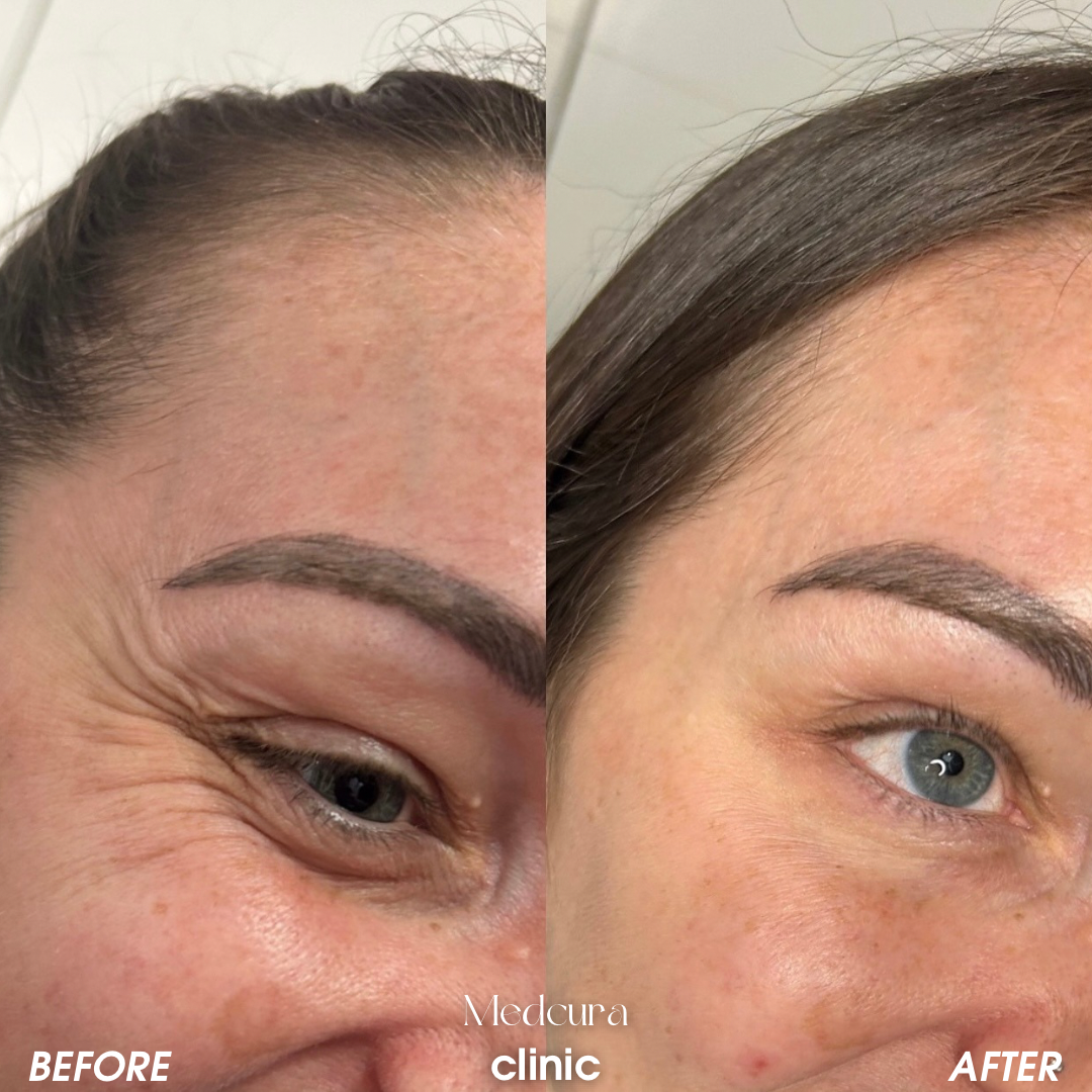 Home anti wrinkle injections