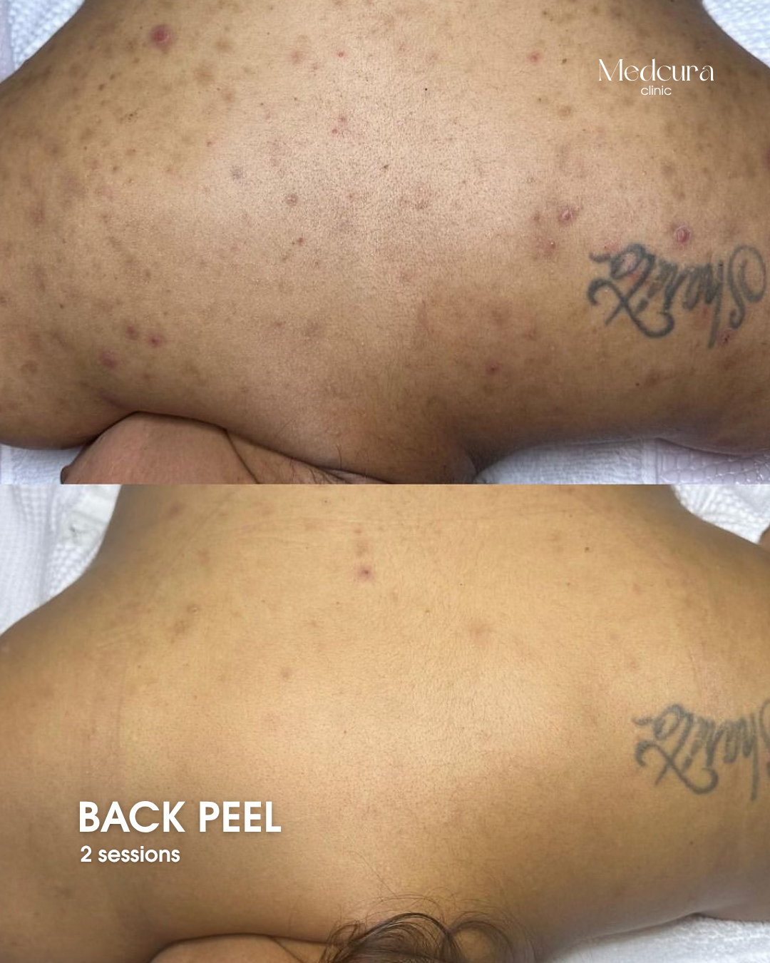 Home back peel