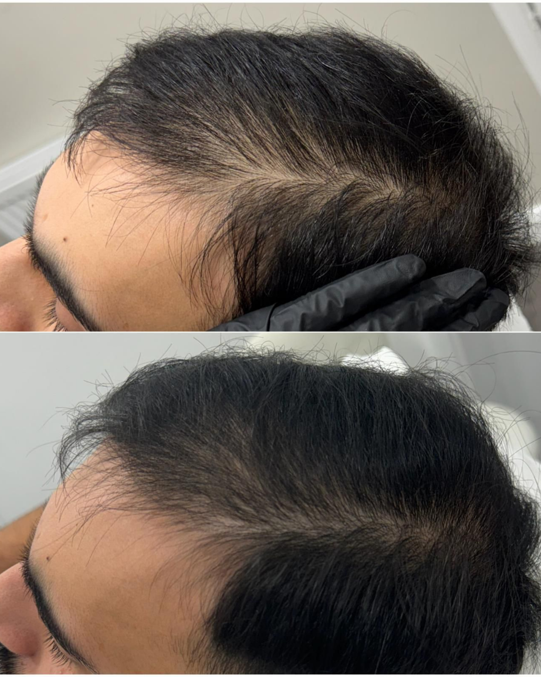 Home prp hair restoration