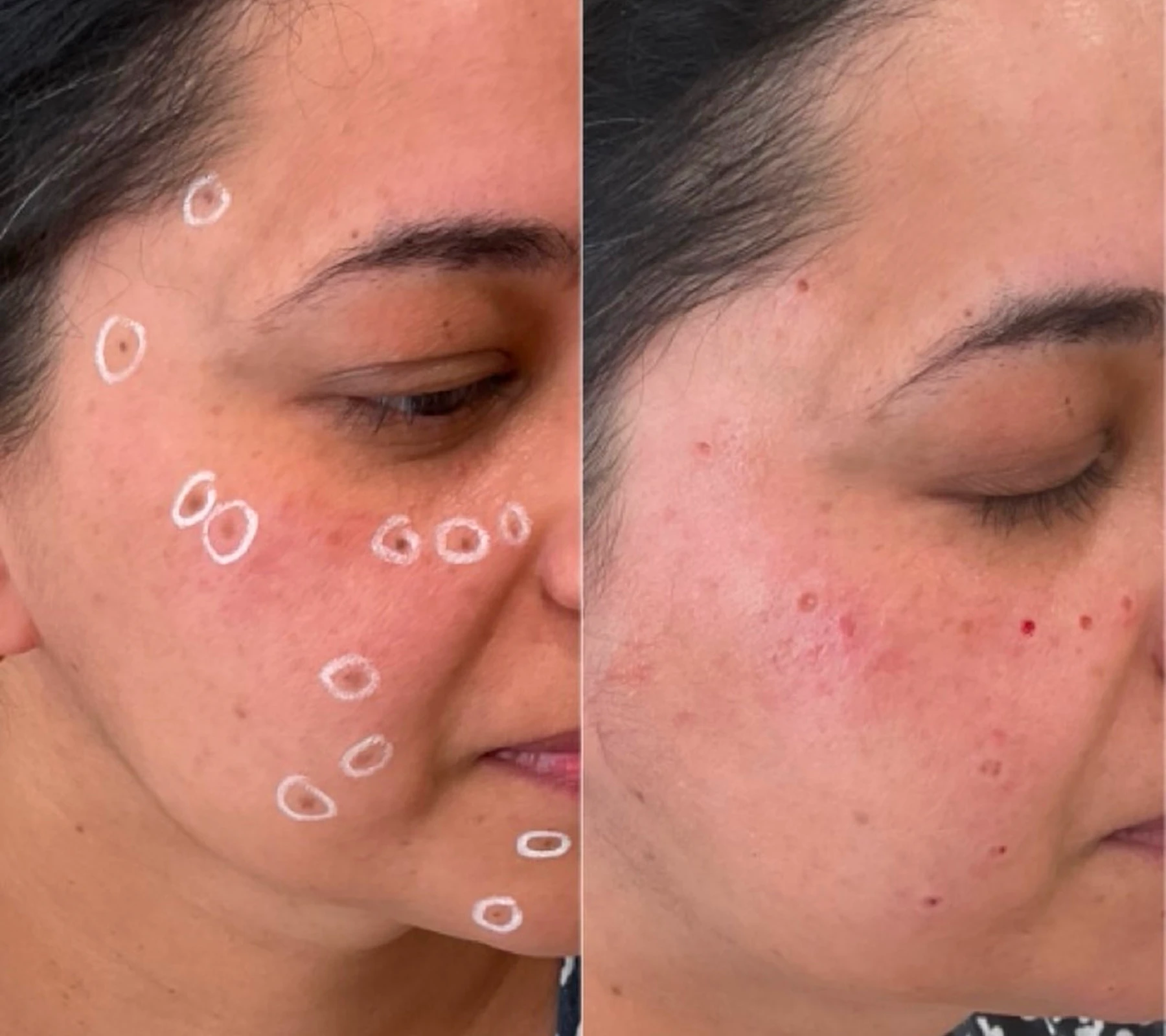 Home Acne Scarring