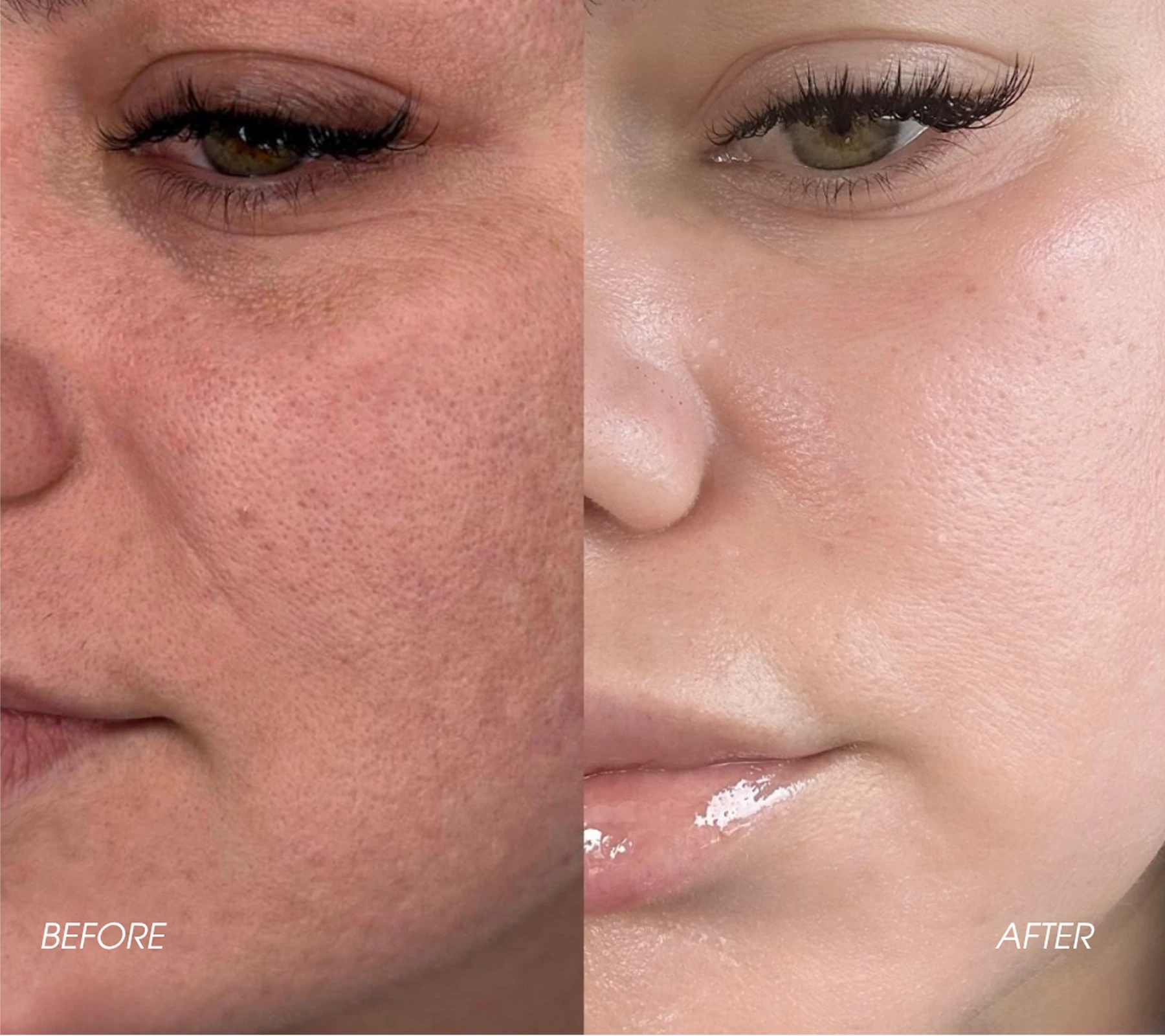 Home Dermal Fillers