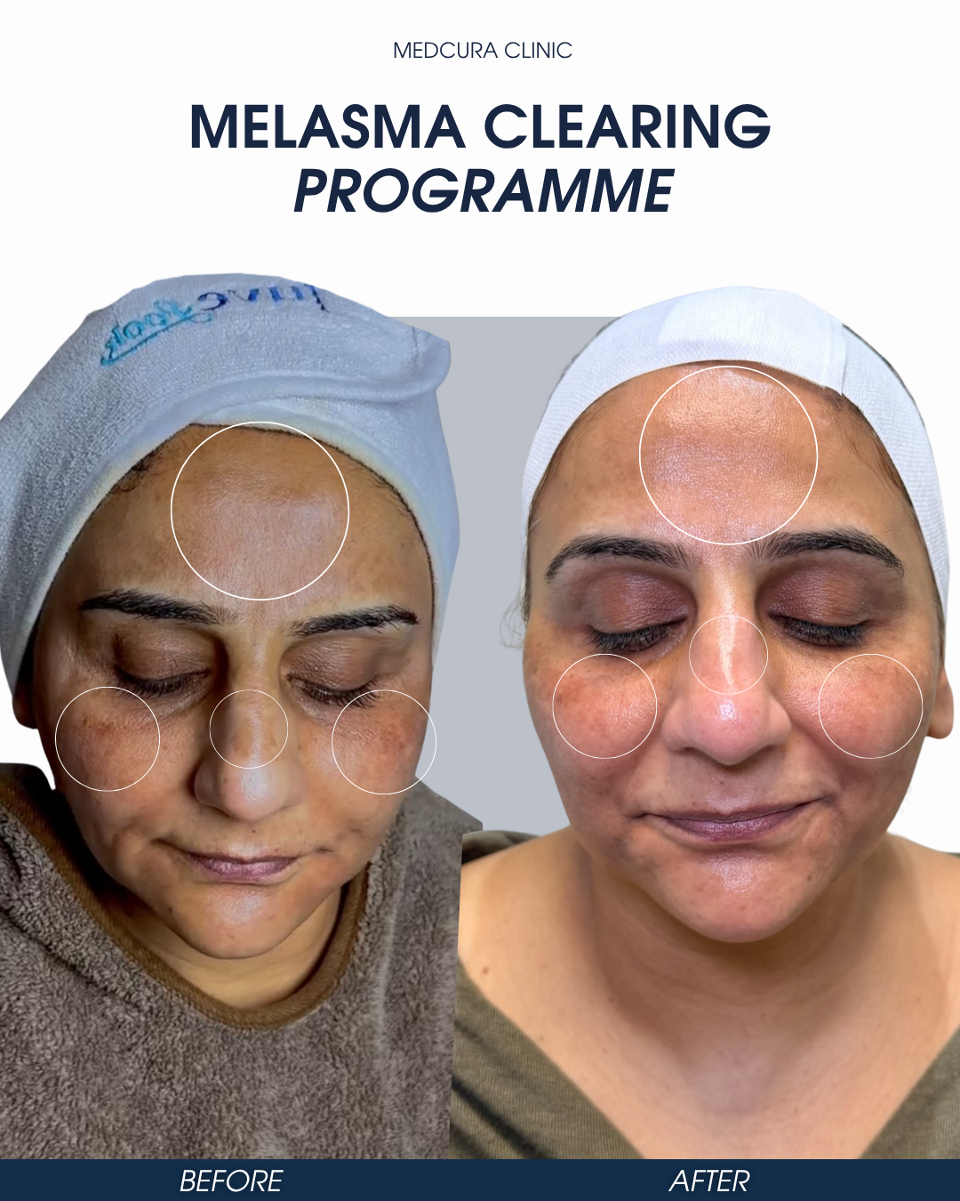 Home melasma clearing programme