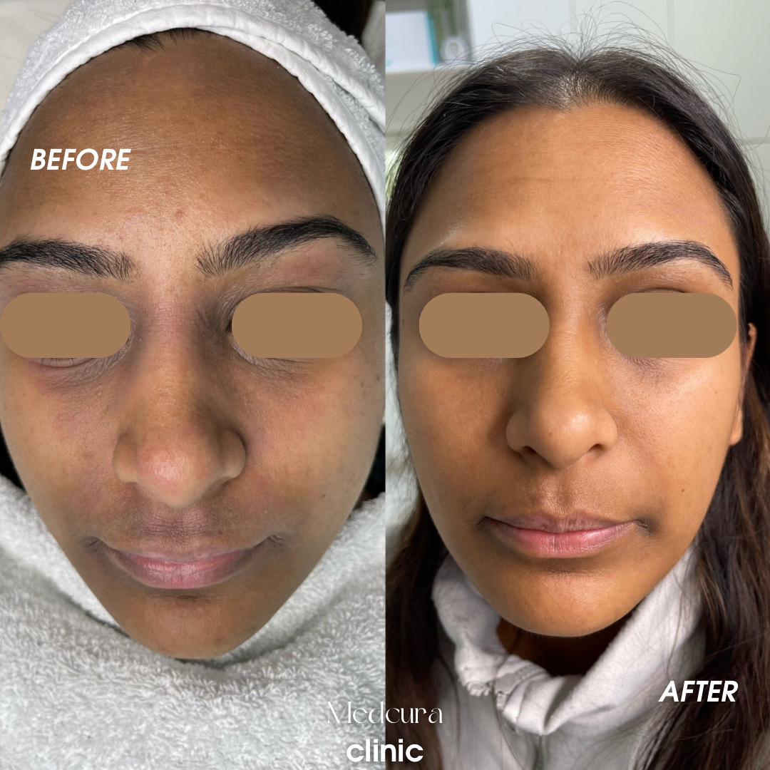 Home pigmentation removal with microneedling exosomes