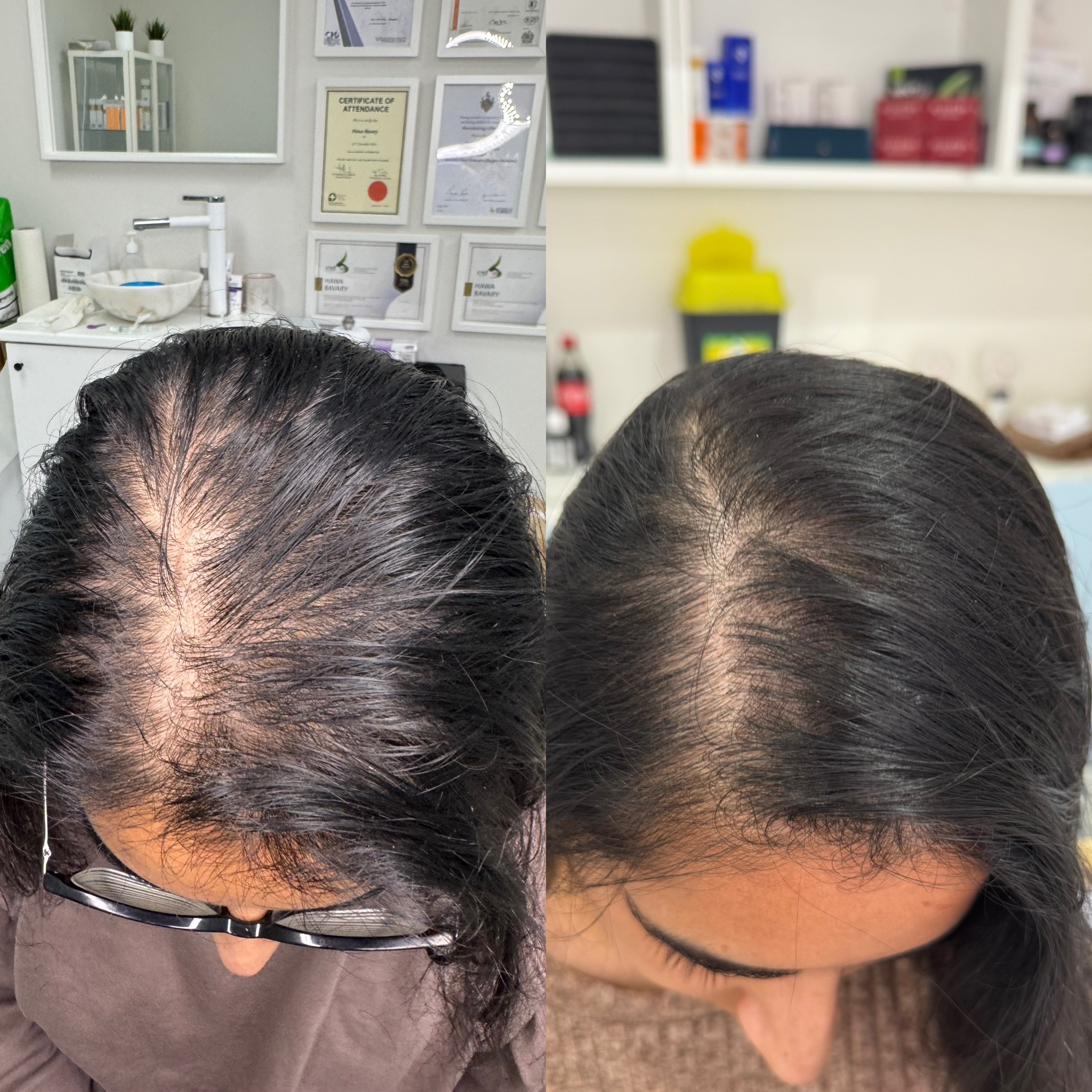 AUTOLOGOUS hair growth