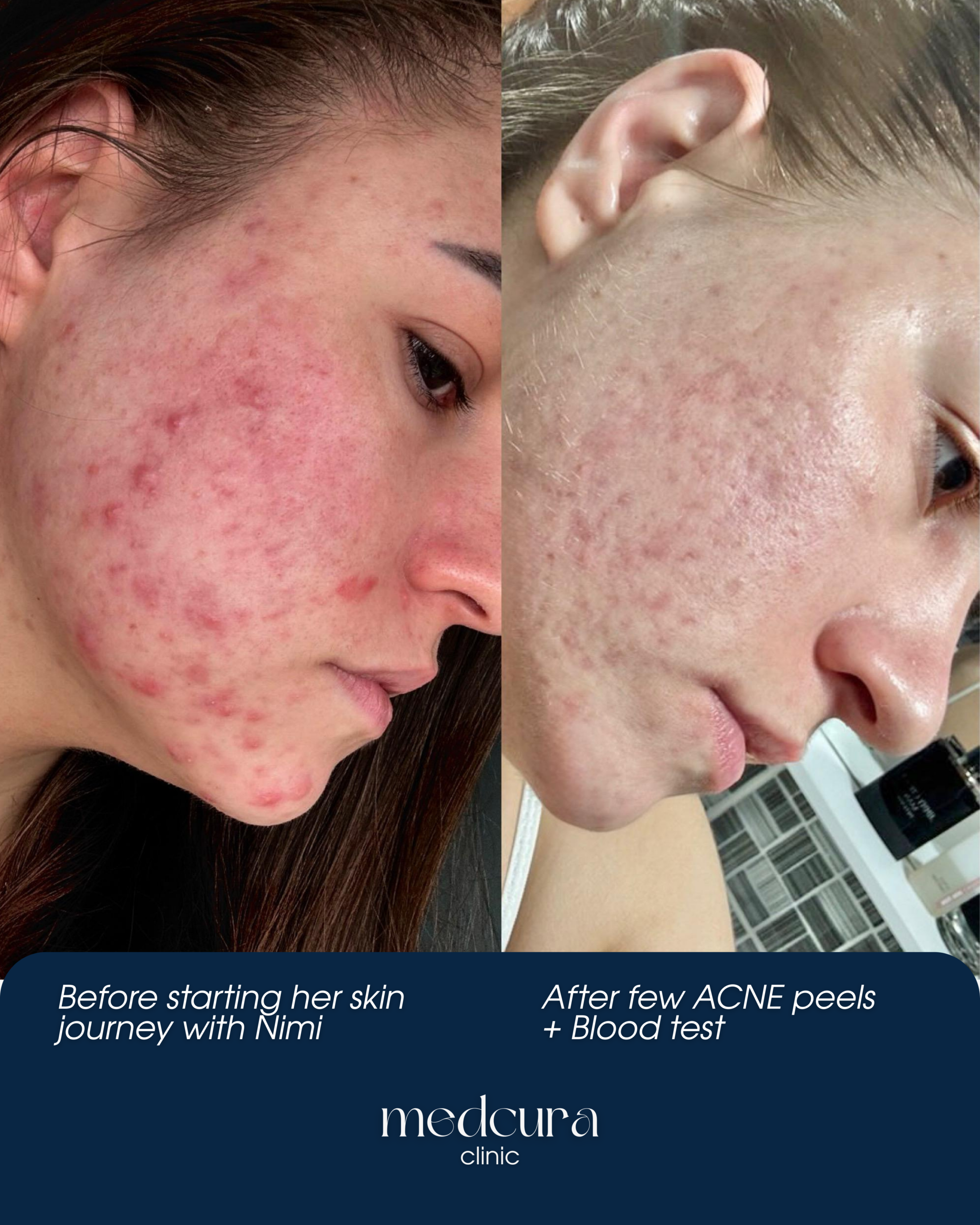 Acne Clearing Programme (1)
