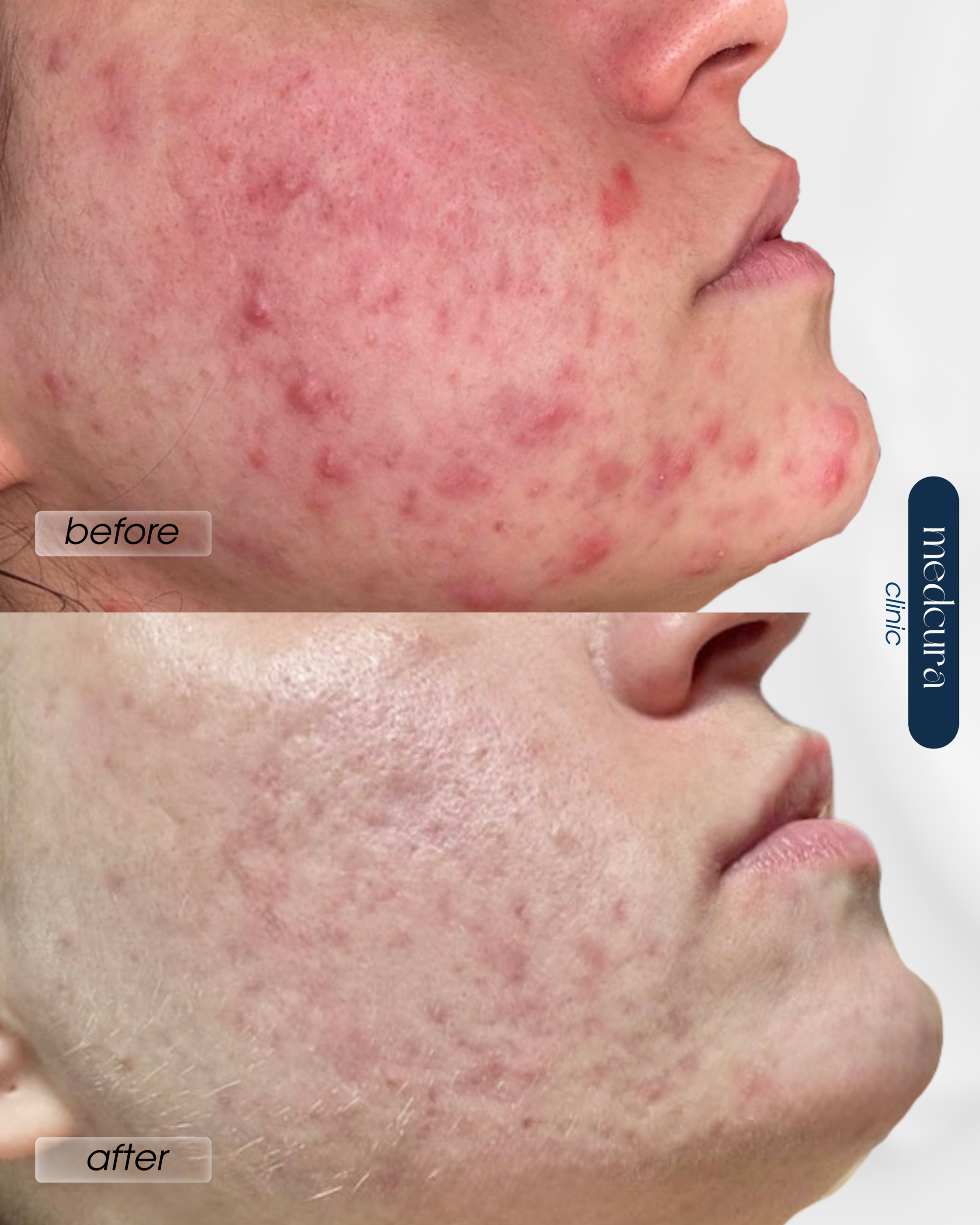 Acne Clearing Programme (2)(1)
