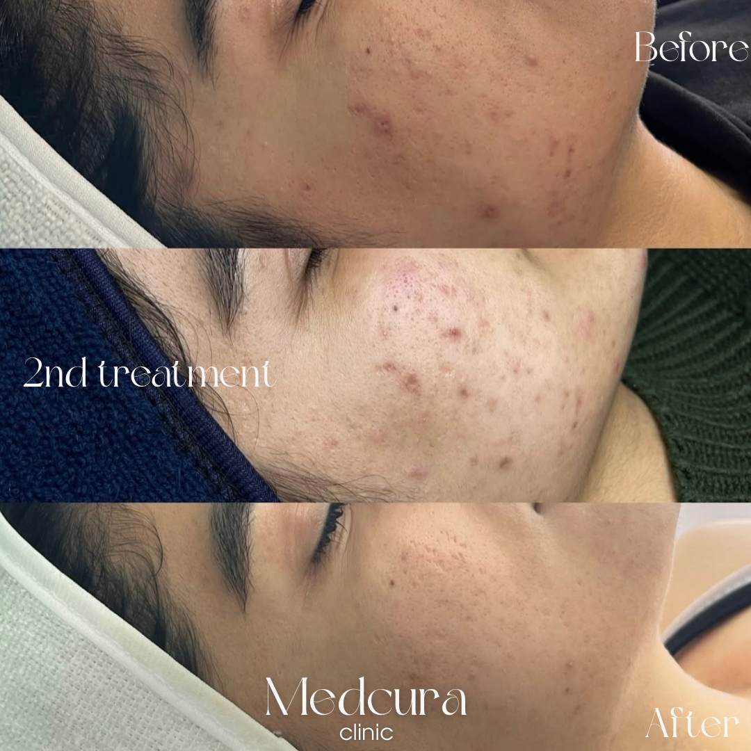 Acne Clearing Programme in Harrow