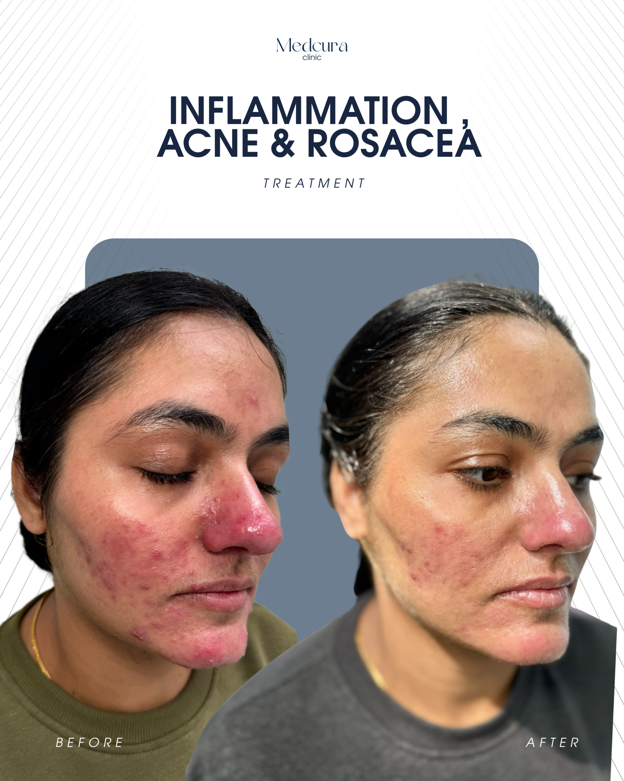 Acne Clearing Programme