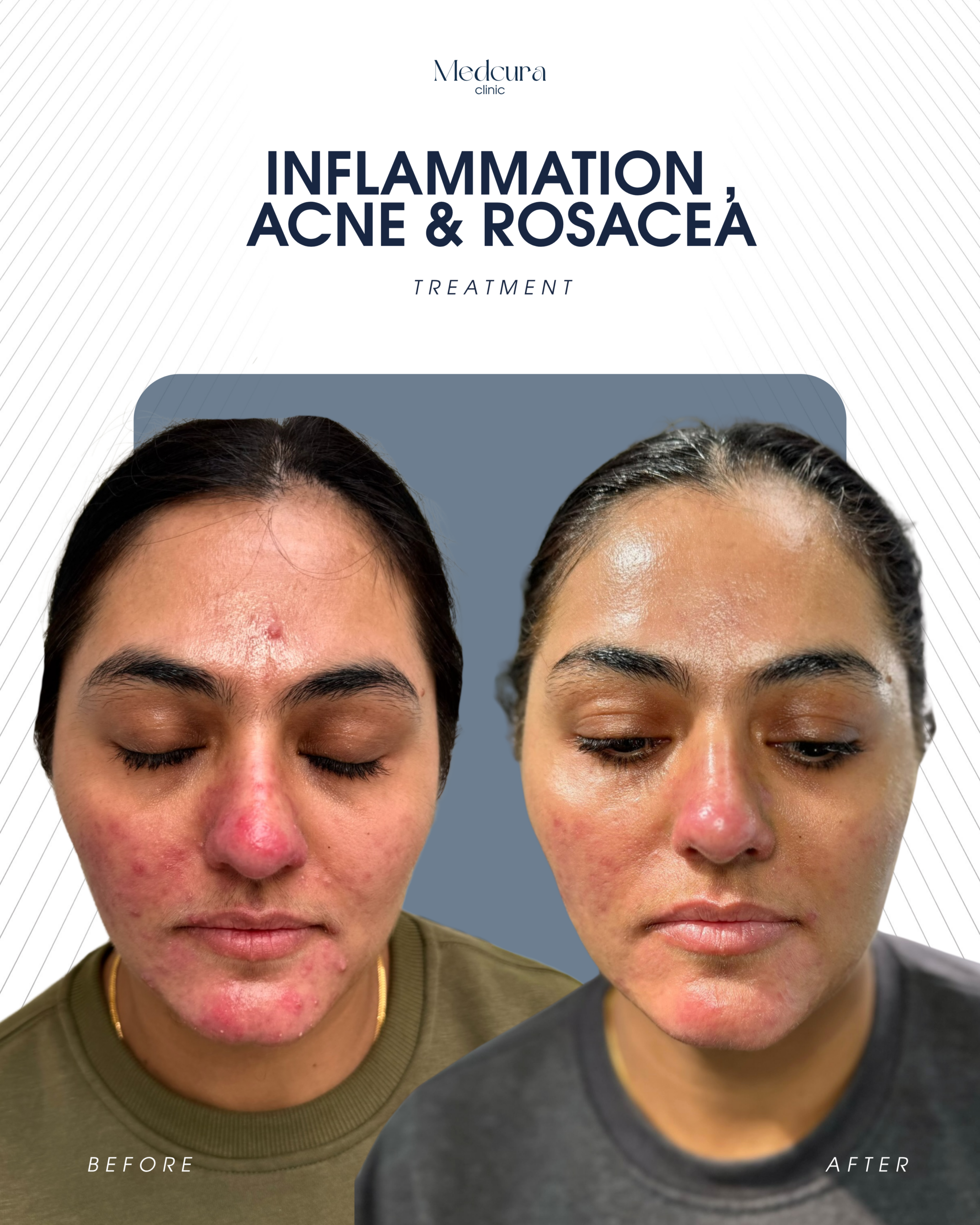 Acne Treatment in Harrow