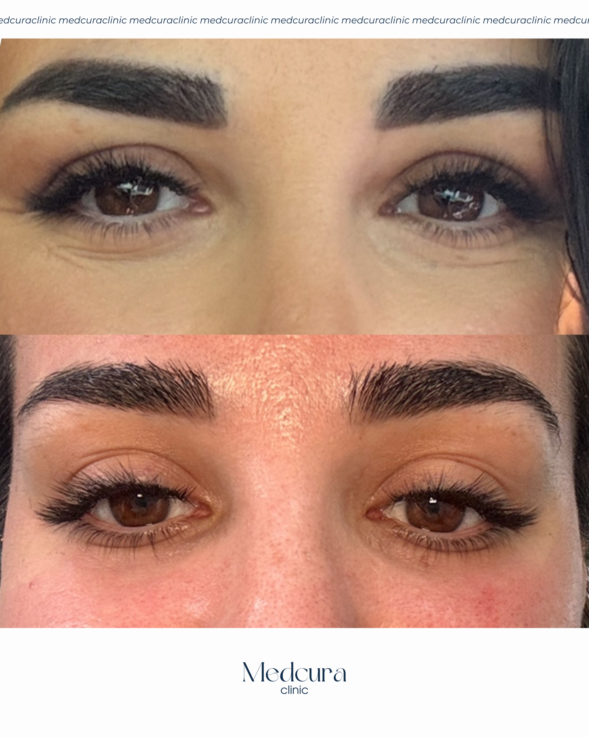 CO2 LASER FOR EYES