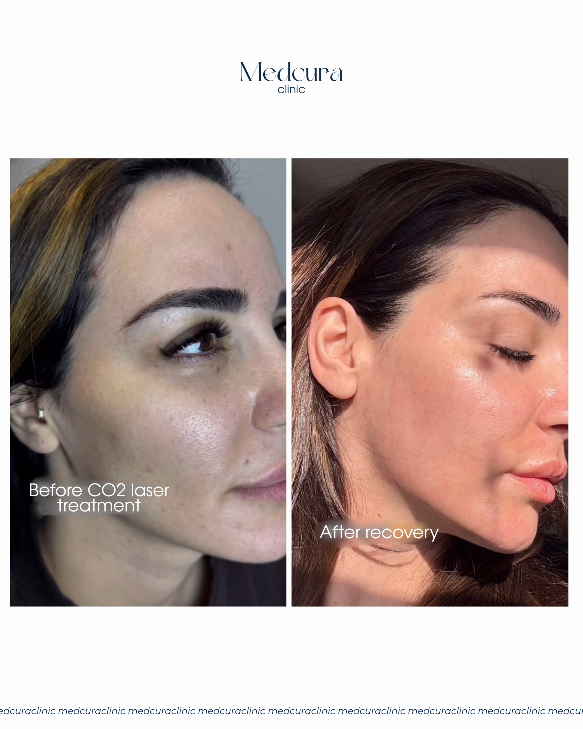 CO2 LASER TREATMENT (3)