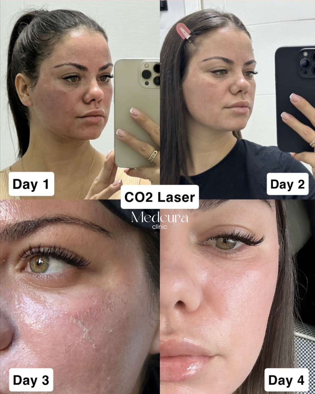 CO2 Laser day by day