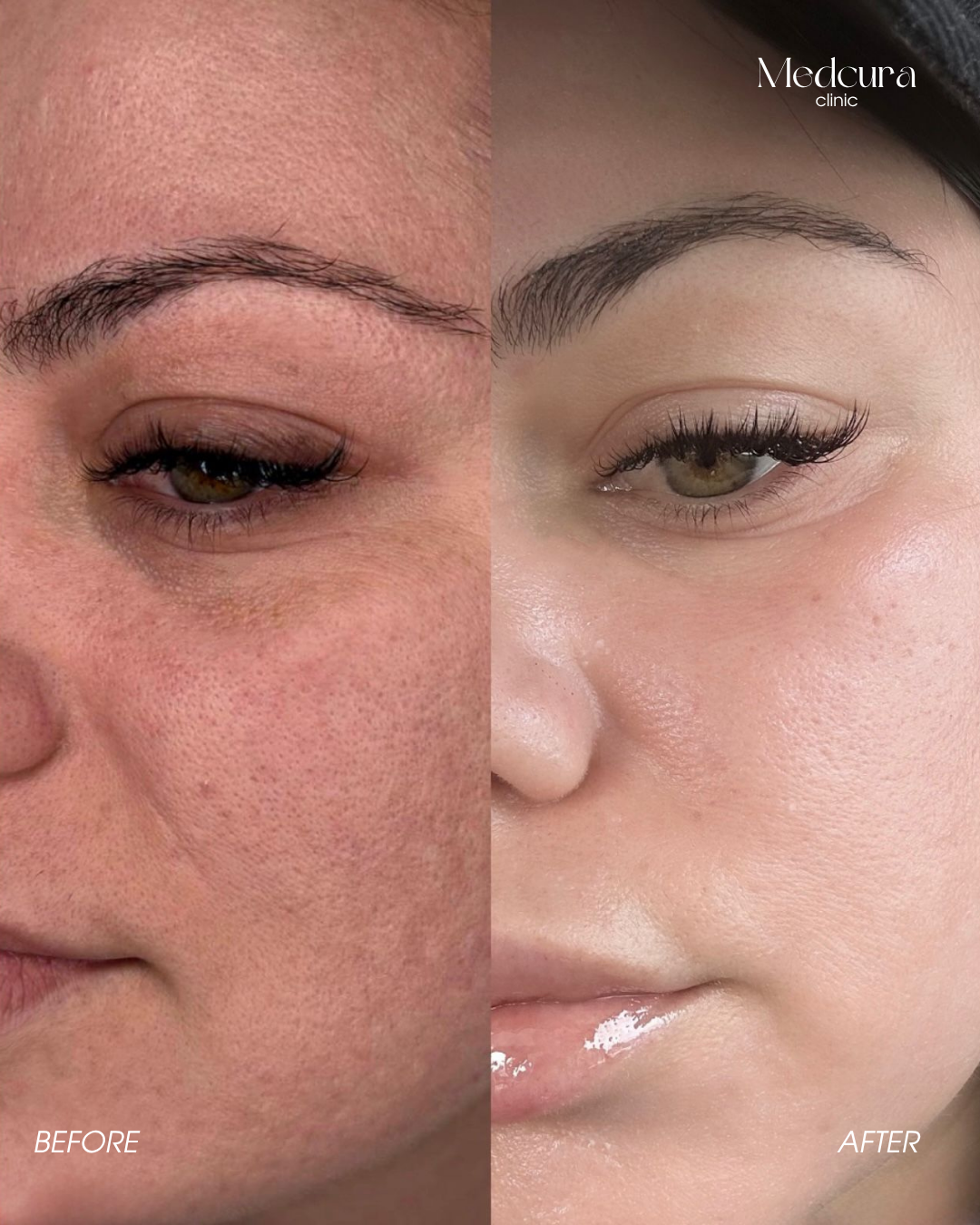 CO2 Laser resurfacing