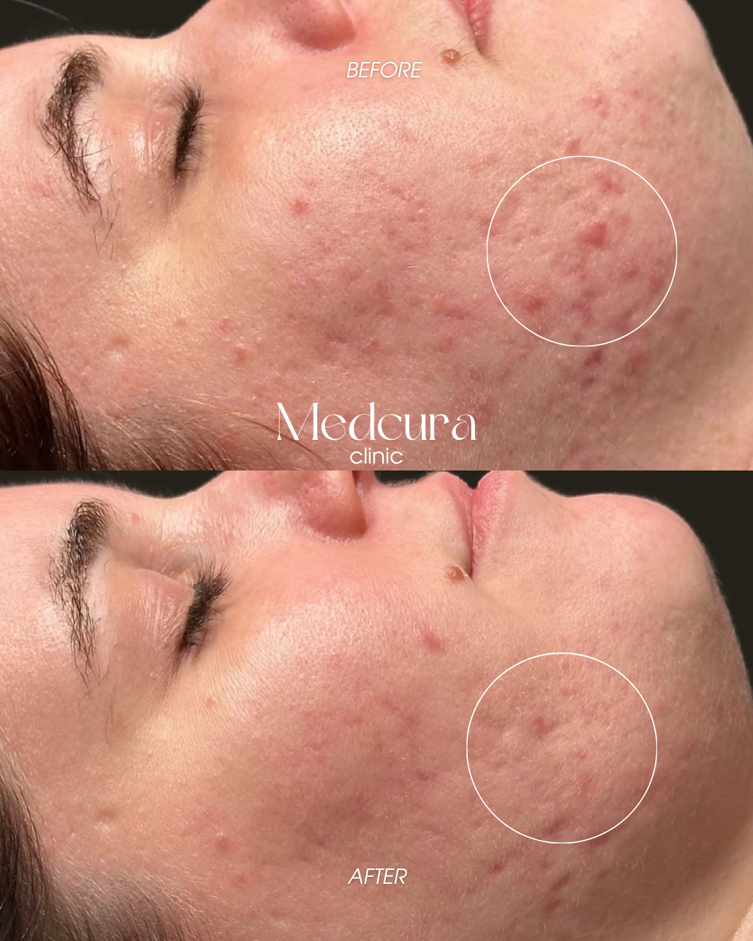 acne clearing programme