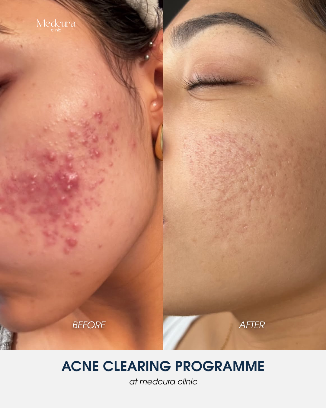 acne clearing programme (2)