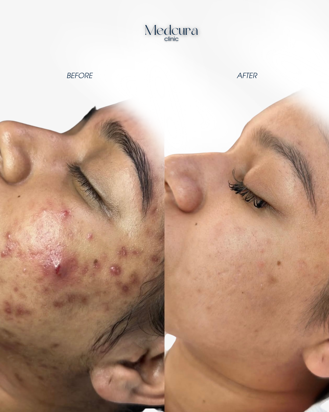 acne clearing programme (4)