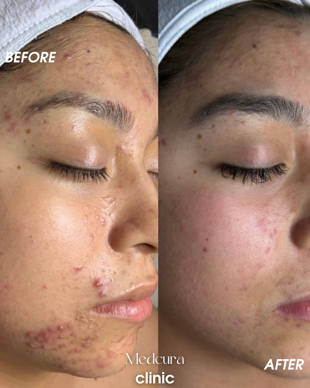 acne clearing programme 4543