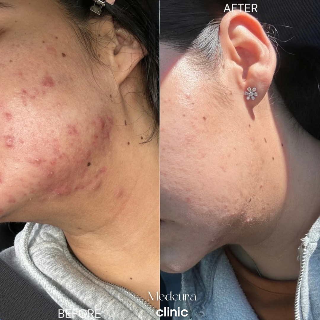 acne clearing progreamm123456
