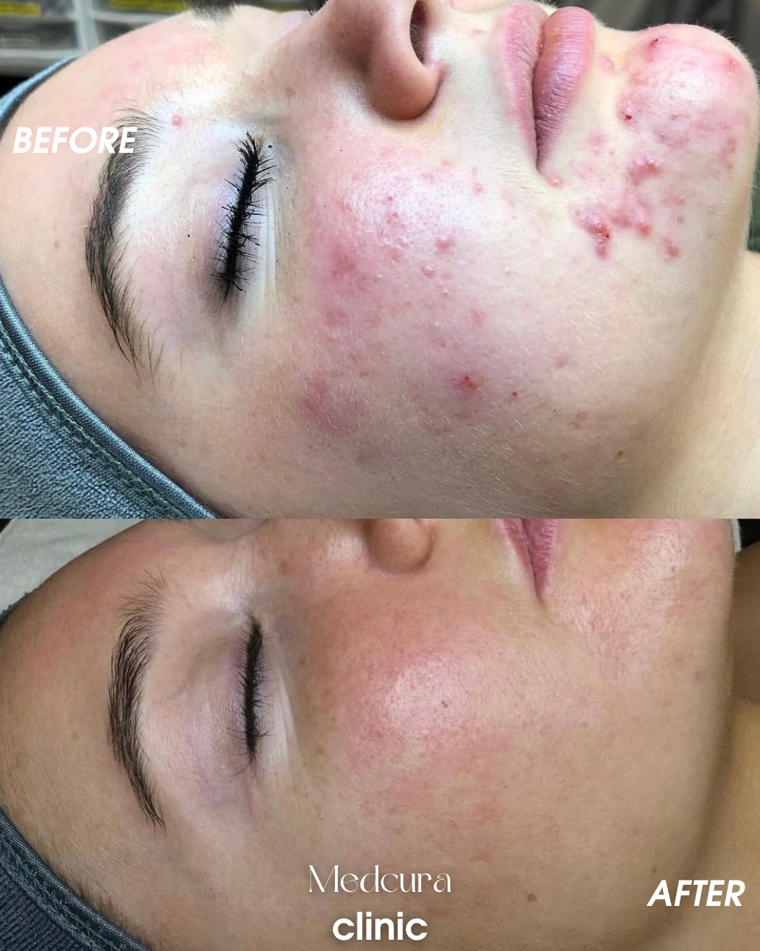 acne clearing traetments 1878