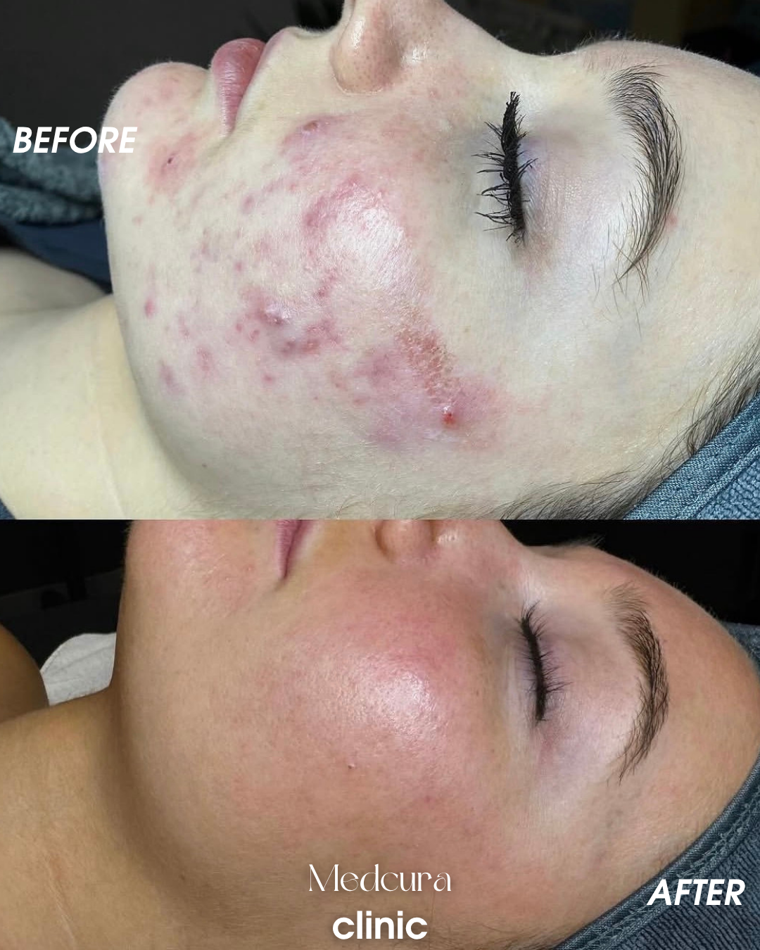 acne clearing treatment 1112348