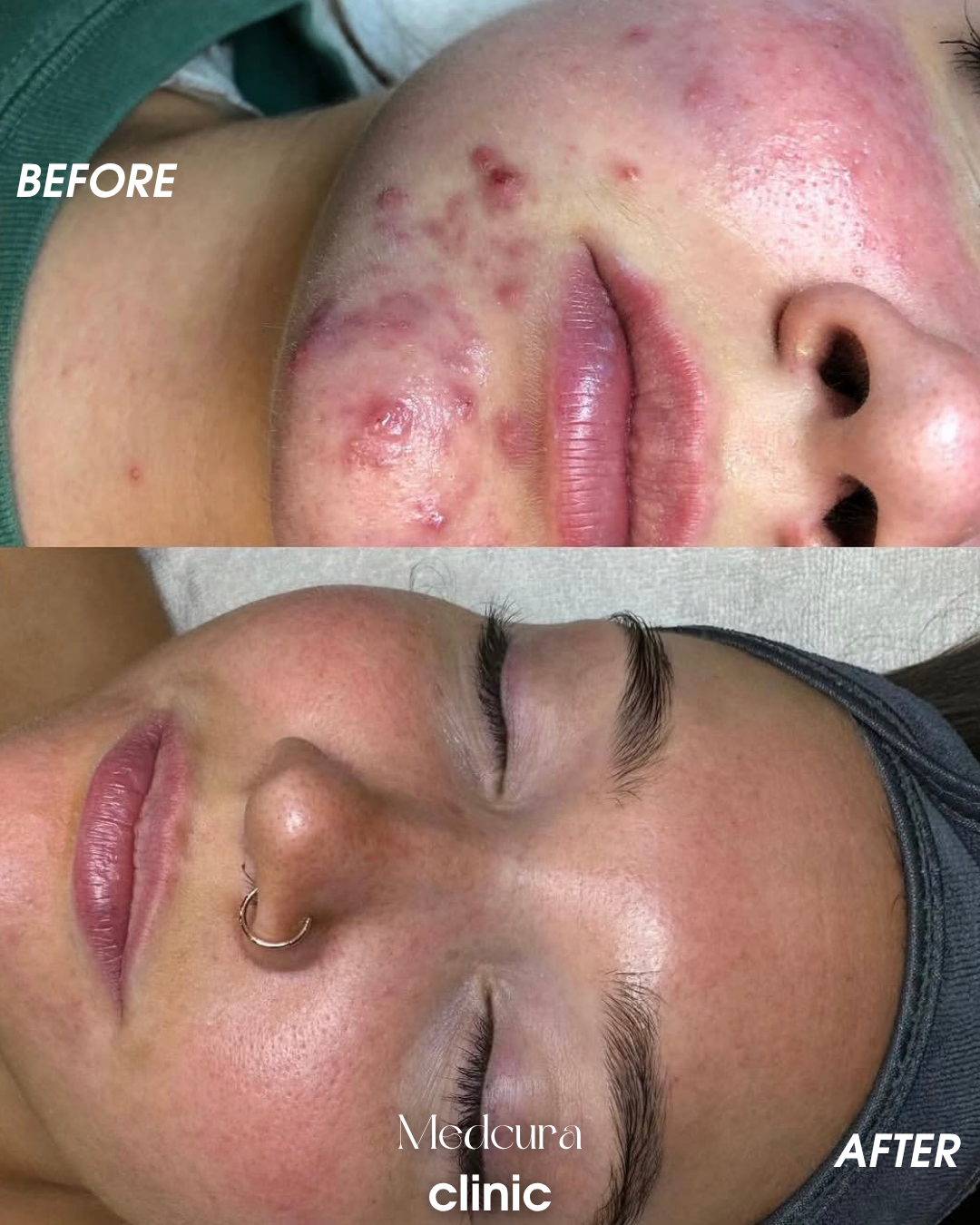 acne clearing treatment 18773