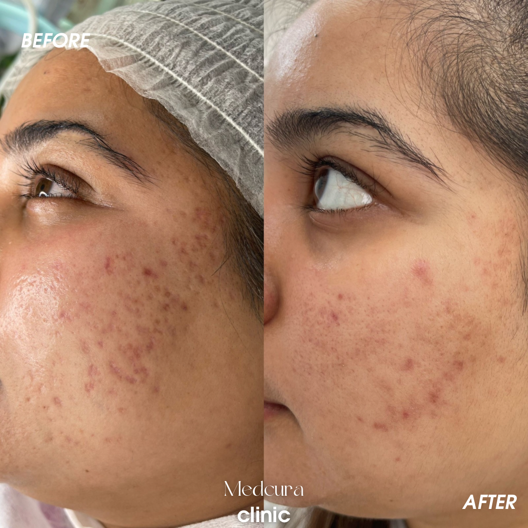 acne scars removal