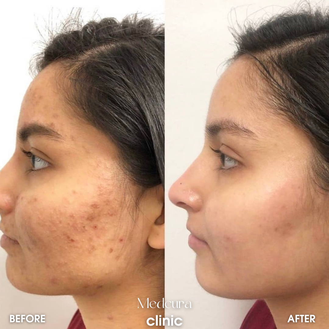 acne scars with microneedling exosomes 12111