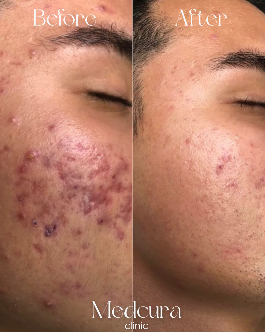 acne treatment Harrow UK