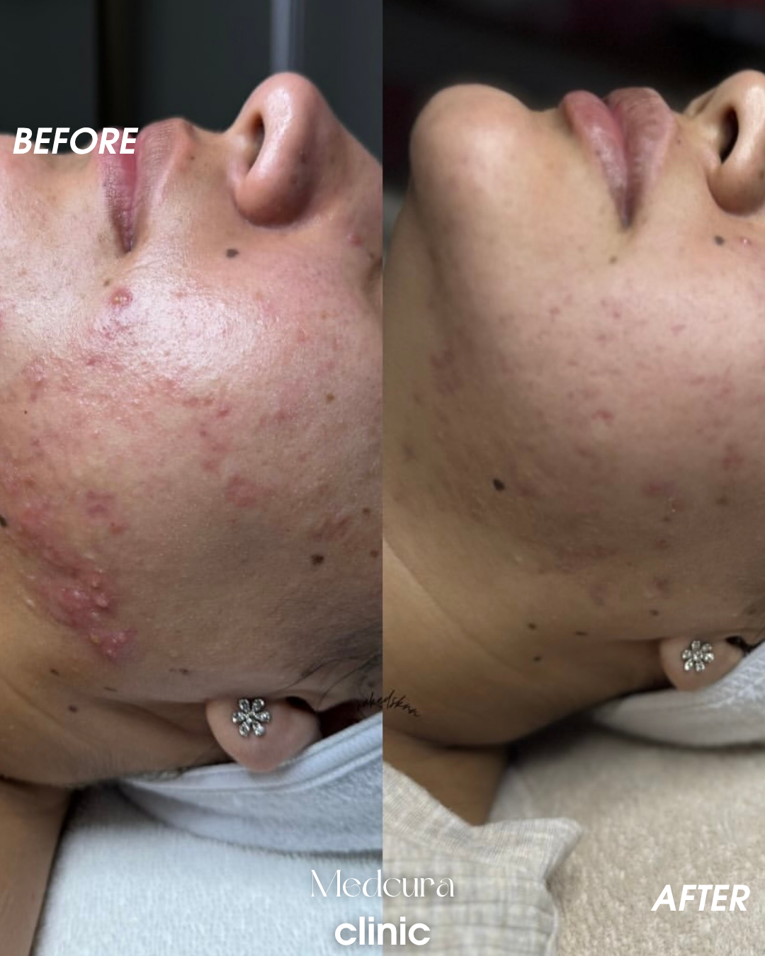 acne treatment Harrow