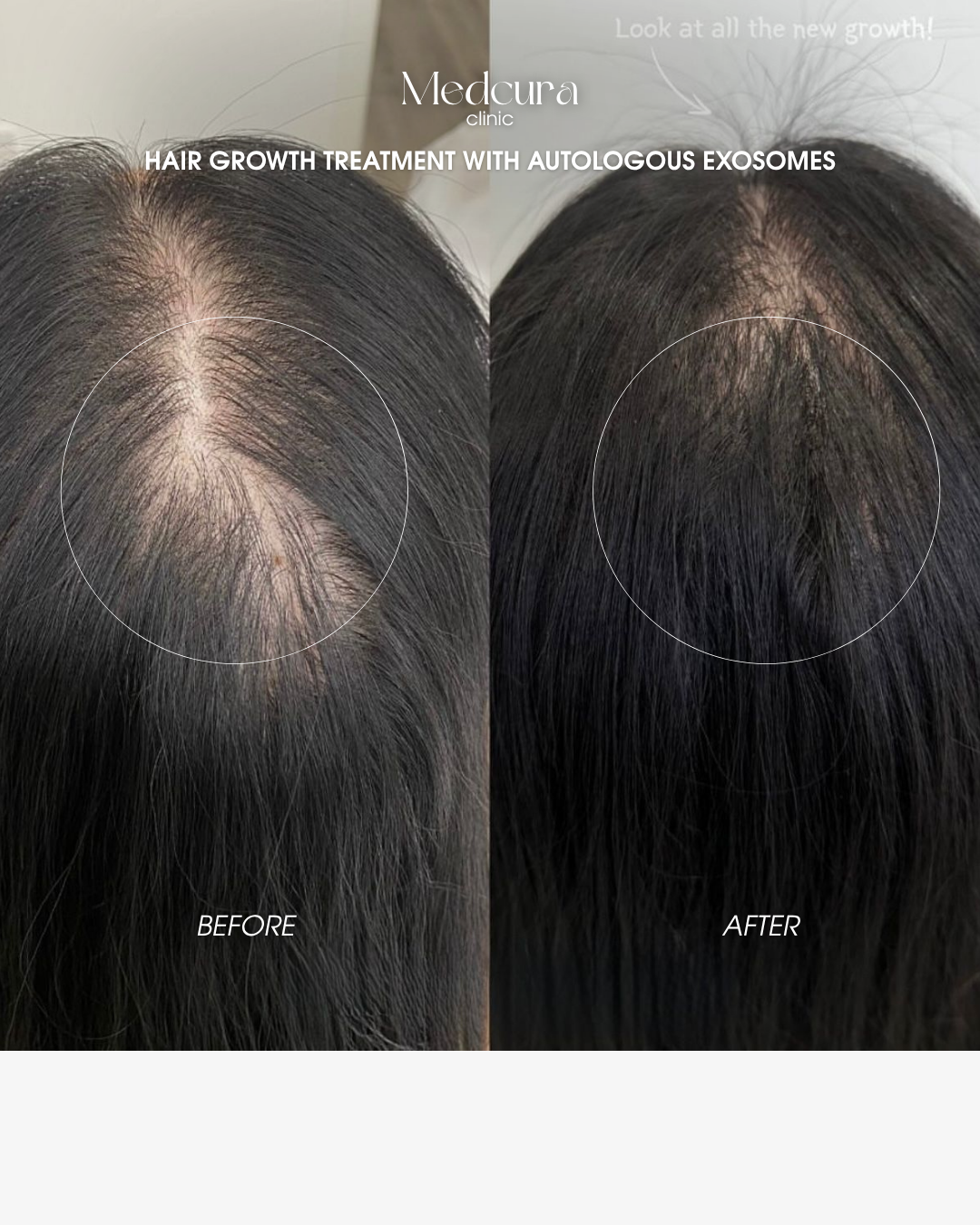 autologous exosomes hair treatment