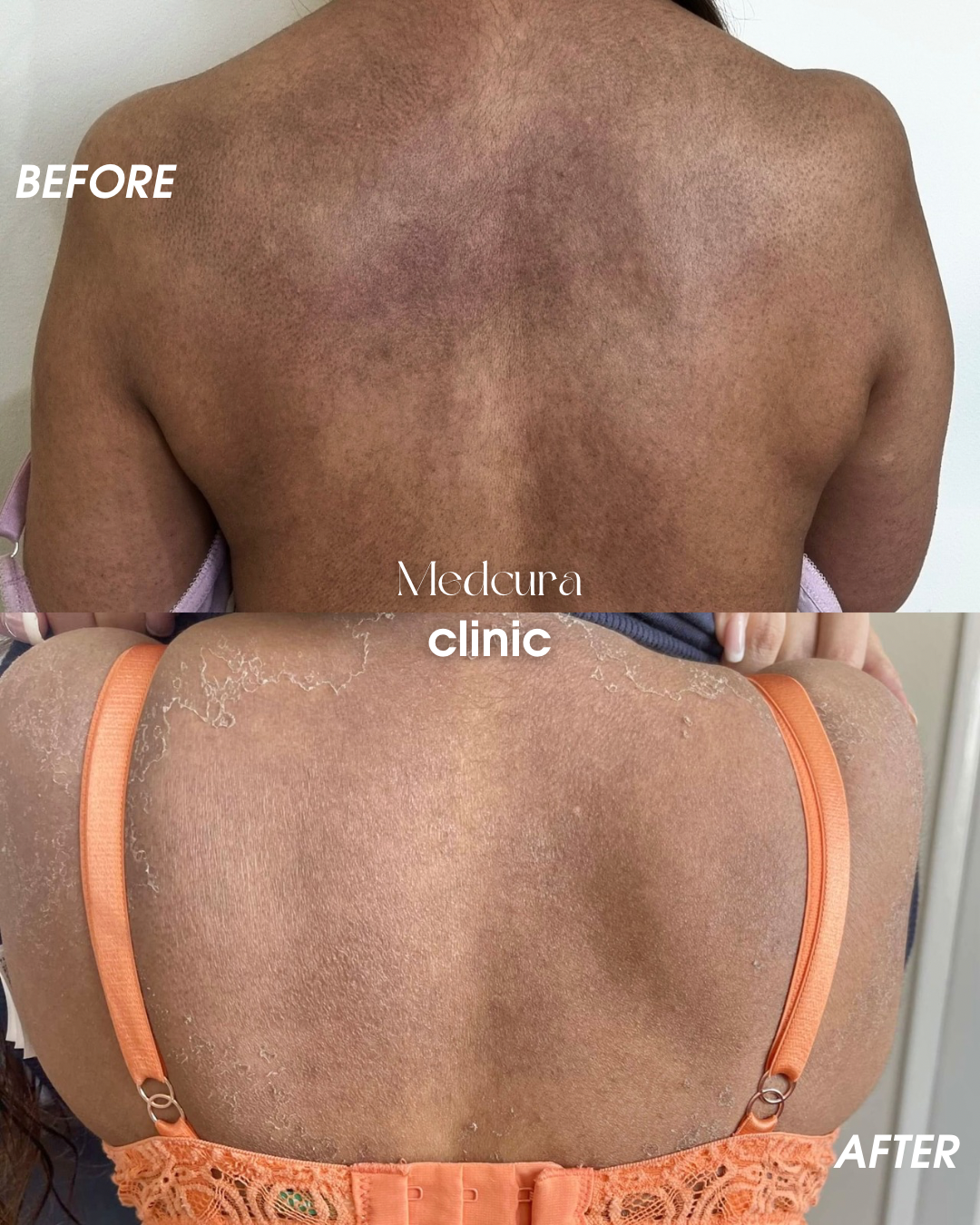 back peel 12