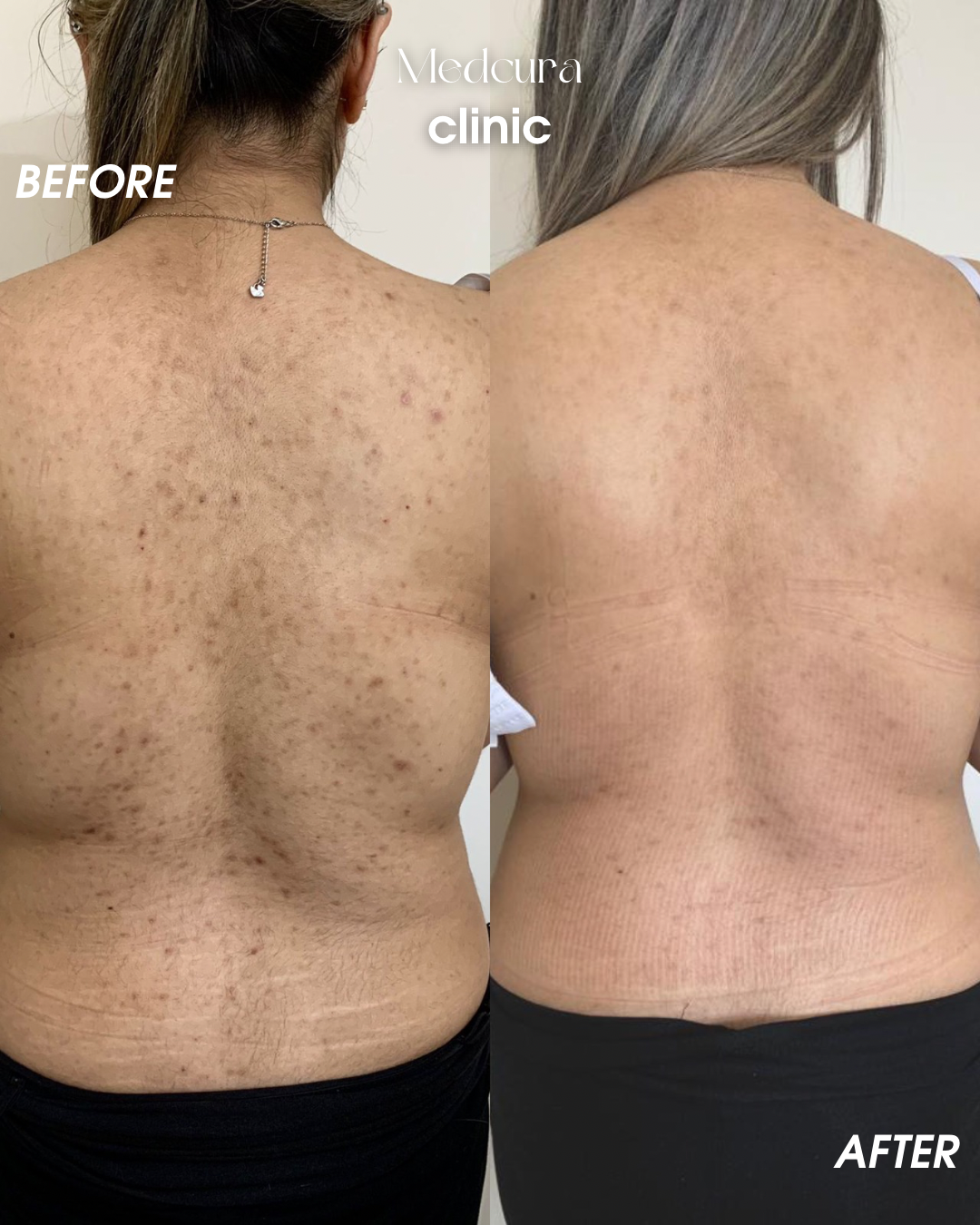 back peel 7713